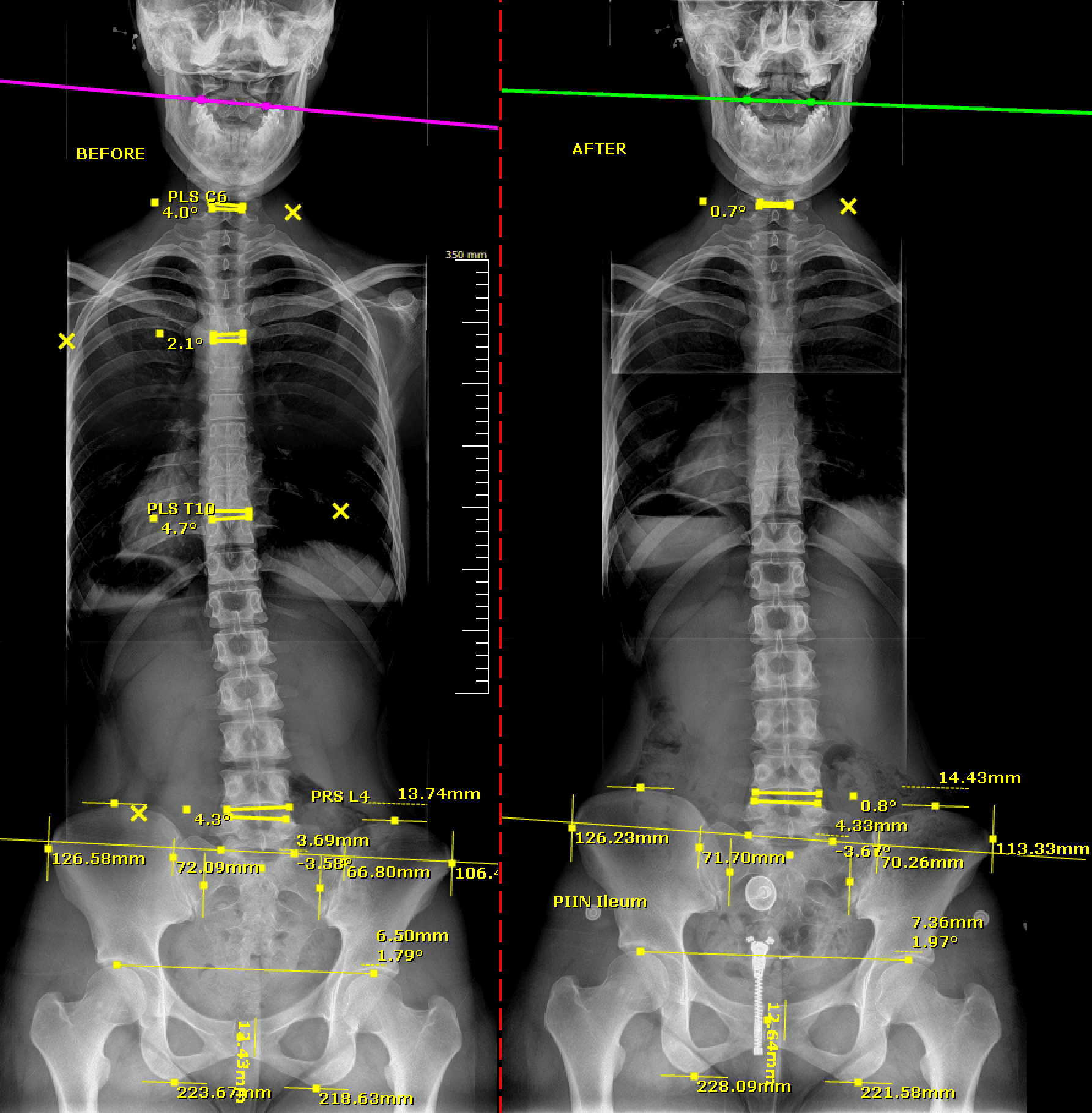 Before and after AP spinal X-ray comparison showing improved cervical, thoracic, and pelvic alignment measurements