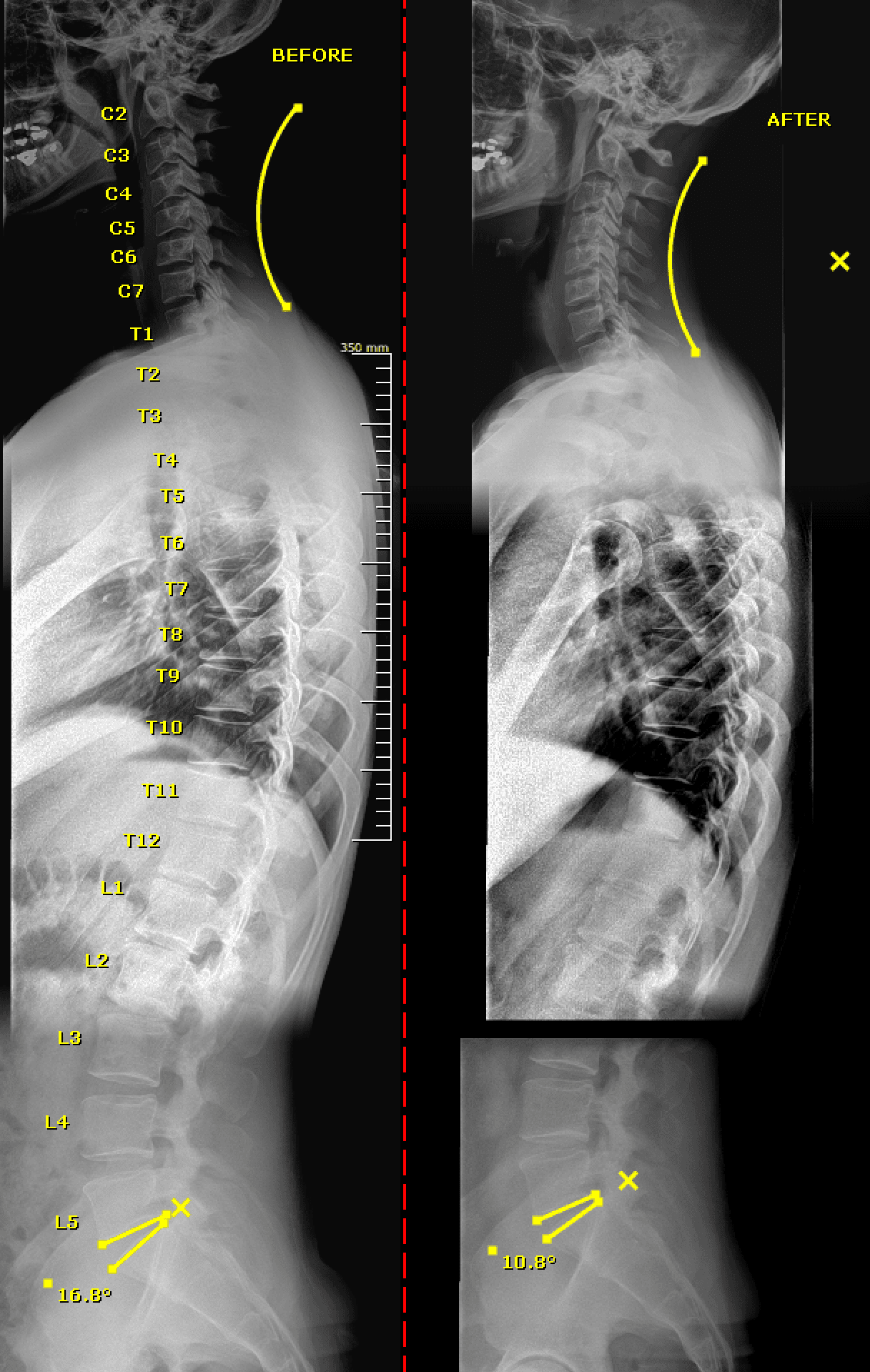 Before and after lateral spinal X-ray comparison showing improved cervical curve
