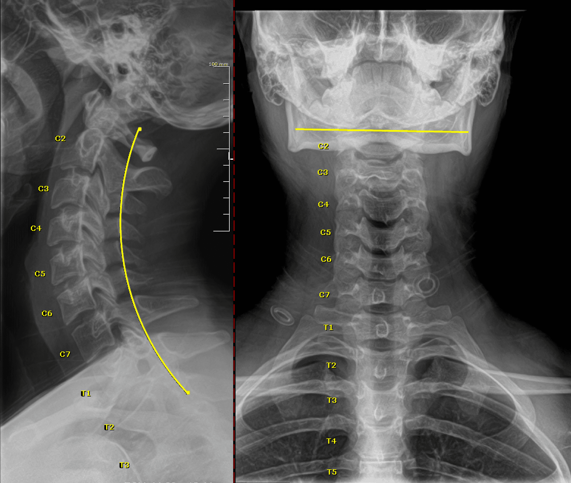 After chiropractic care: cervical X-ray showing improved cervical curve and alignment